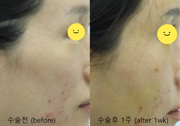 A Specialized Fat Grafting Correction Method for Hollowed Side Cheeks image 7