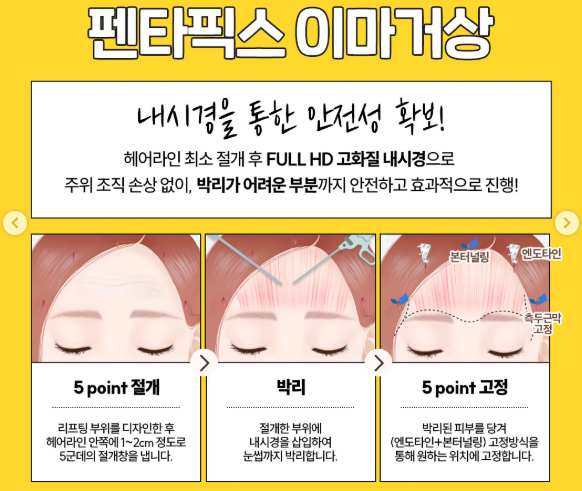 미간주름의 원인과 치료 관련 이미지 4