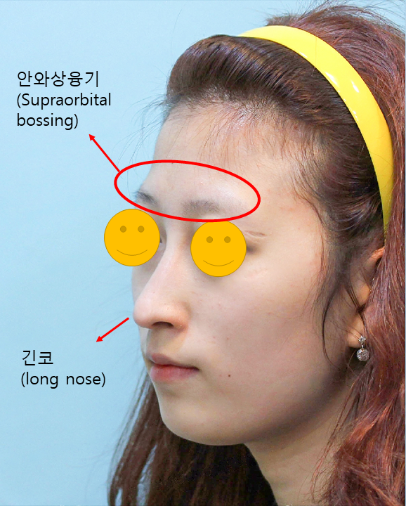 중안면이 긴 얼굴의 코성형과 지방이식 관련 이미지 2