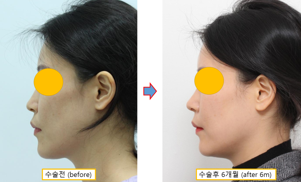 얼굴 지방이식 유지기간, 3·6·9개월 경과로 알아보는 생착과정 관련 이미지 6