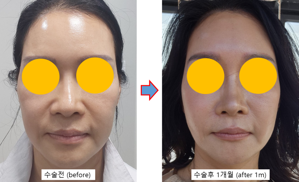 실리프팅, 어떤 실을 어떻게 사용하느냐가 중요한 이유 관련 이미지 6