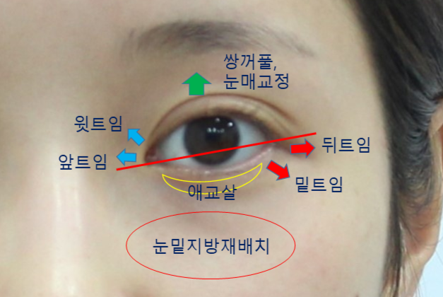 눈 아래부분을 화려하게 만드는 눈성형 관련 이미지 1