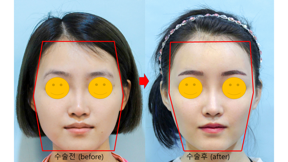 얼굴의 입체감을 살려주는 지방이식 관련 이미지 3