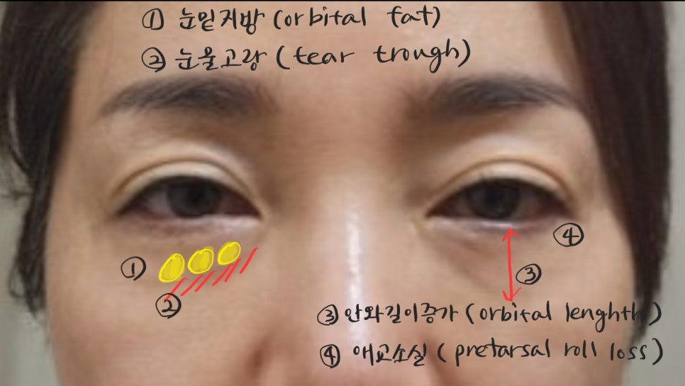 애교살을 보존하는 하안검 수술 관련 이미지 3