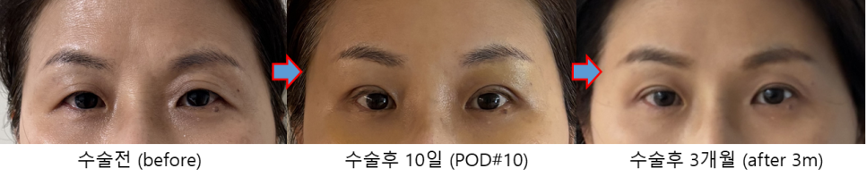 50대 쌍꺼풀 수술, 이마거상과 함께해야 자연스러운 이유 관련 이미지 4