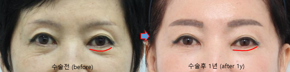 눈밑 수술을 하지 않았는데, 눈밑이 좋아졌습니다 관련 이미지 4