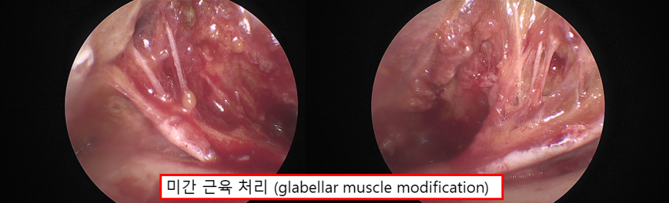 보톡스 맞으면 되는데, 이마거상은 왜 하나요? 관련 이미지 2