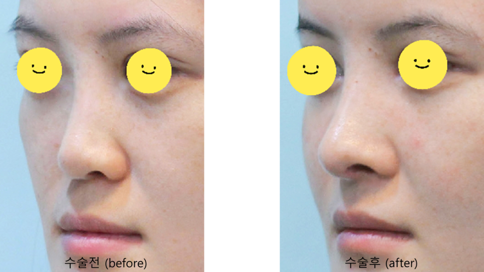 코성형을 통한 중안면부 함몰의 개선 관련 이미지 7