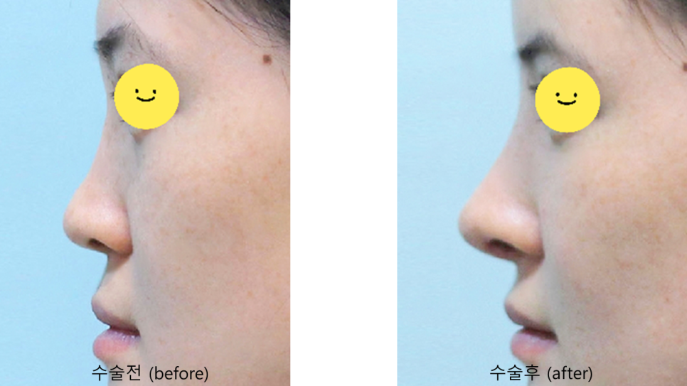 코성형을 통한 중안면부 함몰의 개선 관련 이미지 8
