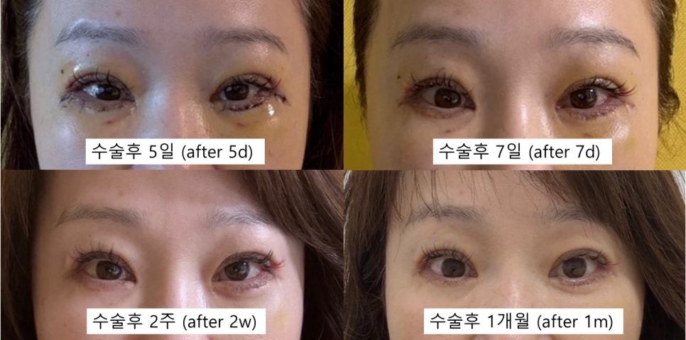 중년눈성형에서 눈매교정이 필요한 경우 관련 이미지 5