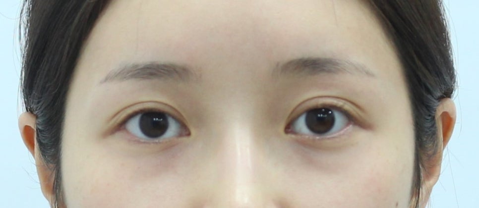 눈 아래부분을 화려하게 만드는 눈성형 관련 이미지 2
