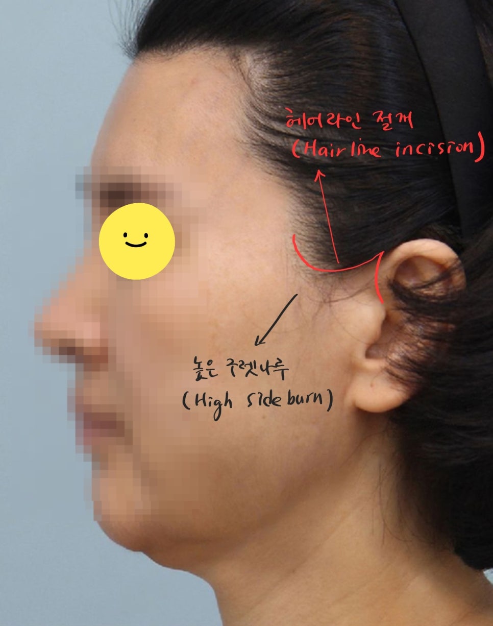 안면거상에서 절개선의 선택방법 관련 이미지 2