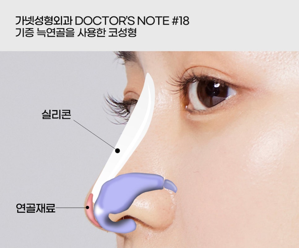 [Garnet Plastic Surgery Director Baek In-soo's Plastic Surgery Column] Rhinoplasty Using Donated Rib Cartilage image 6