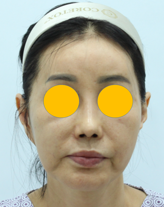 안면거상 재수술에서 수술 방법의 선택 관련 이미지 2