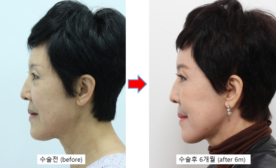 자연스러운 안면거상의 최종결과 관련 이미지 3
