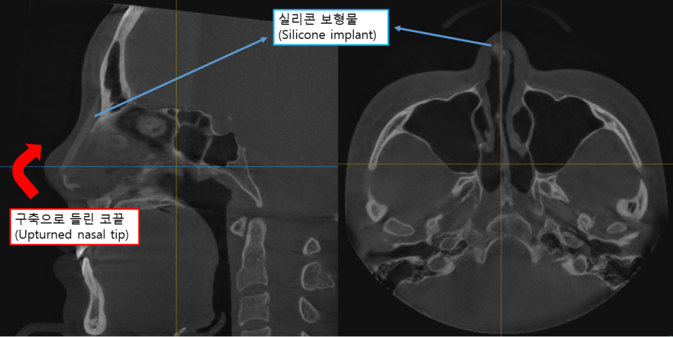 실리콘 부작용 구축코, 자가 늑연골 코재수술로 자연스럽게 복원하기 관련 이미지 2