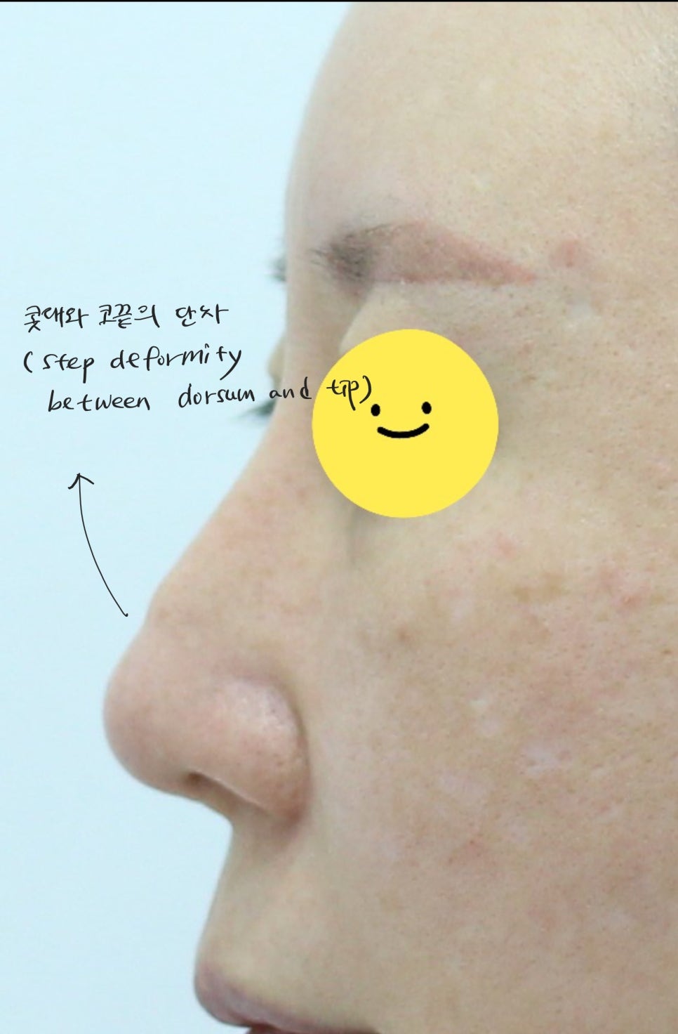 콧대에 실리콘 보형물을 늑연골로 대체하는 경우 관련 이미지 2