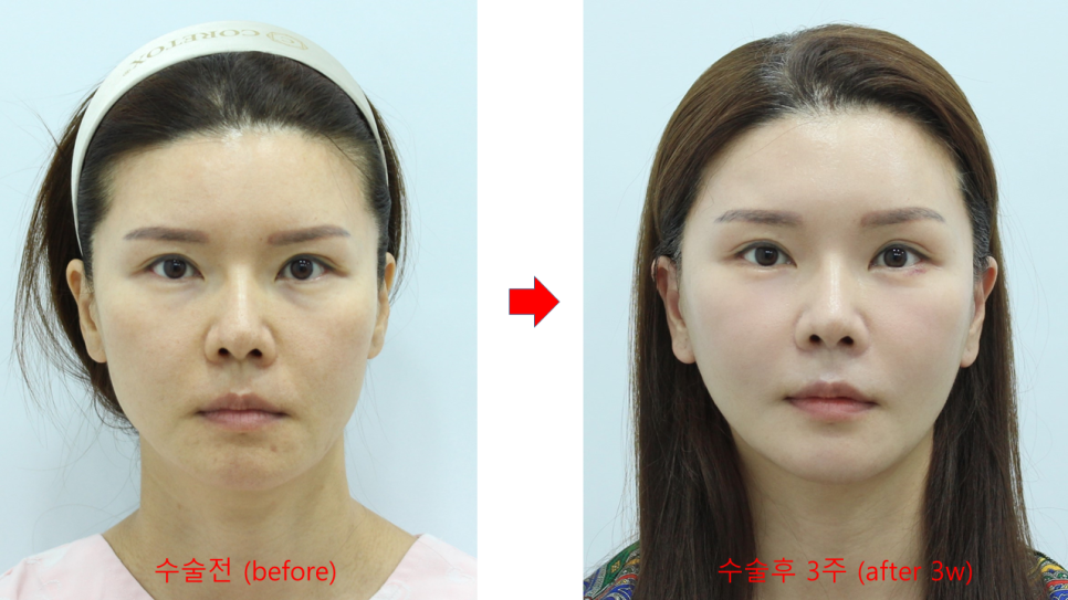 Correcting Cheek Sagging and Sunken Cheeks After Facial Contouring Surgery image 7