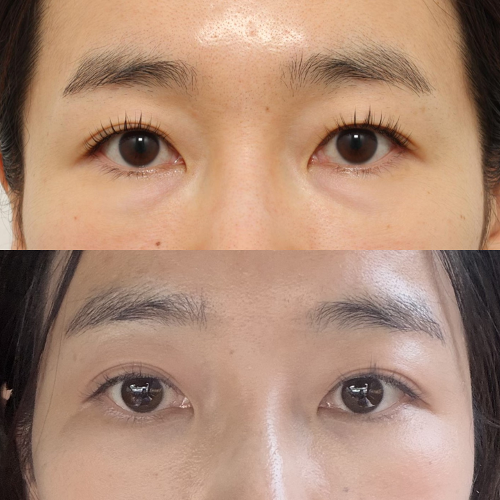 눈밑지방재배치, 다시 재발하나요? 관련 이미지 7