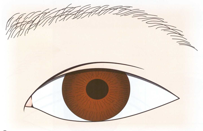 Two-Way Epicanthoplasty for a Cool Semi-Outlook Line image 2