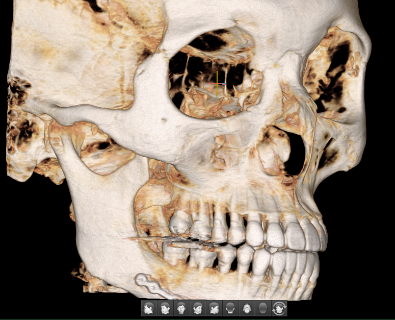 Correcting Cheek Sagging and Sunken Cheeks After Facial Contouring Surgery image 1