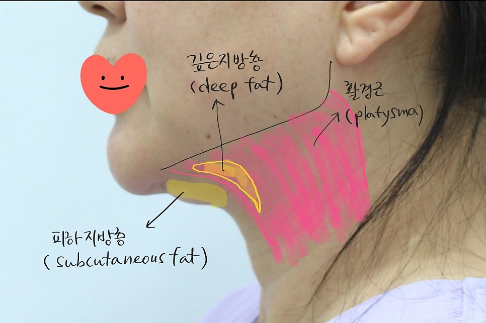 Submental Incision Neck Lift Performed Together with Facelift image 2