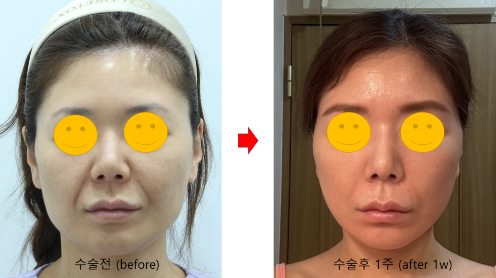 Causes of Nasolabial Folds and How to Address Them image 7