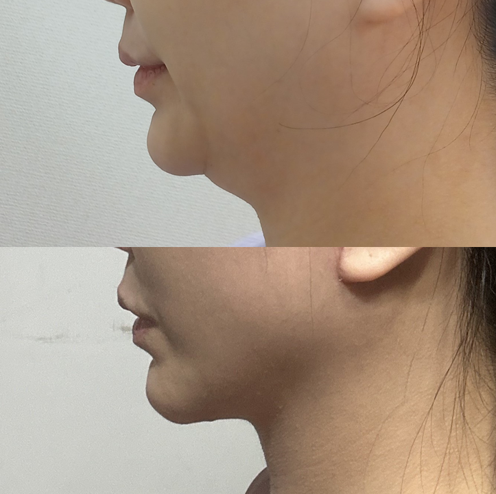 The Evolution of Double-Chin Surgery: From Liposuction to Pelican Surgery image 6