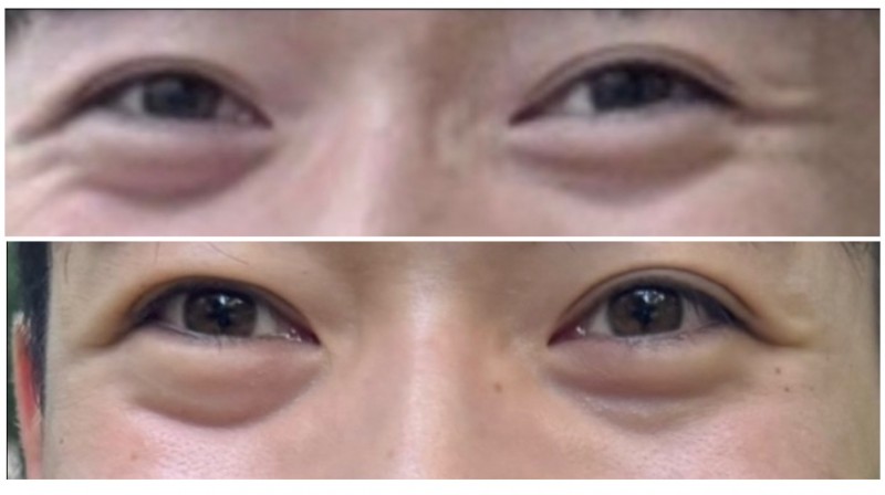 Types of Under-Eye Hollowness and Correction Methods image 3