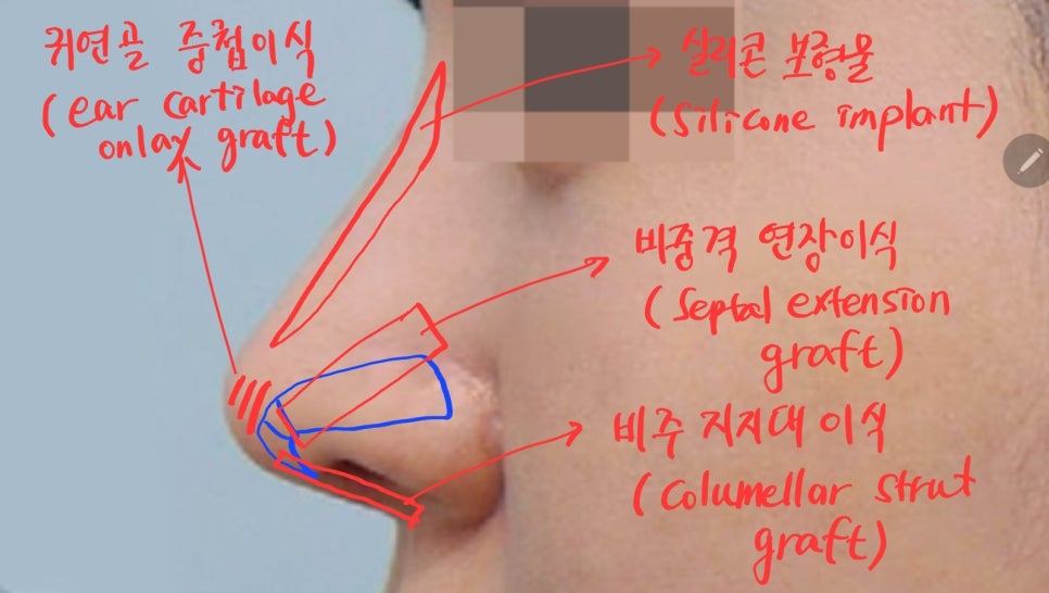 Various Nasal Tip Procedures for Bulbous Nose Correction image 6