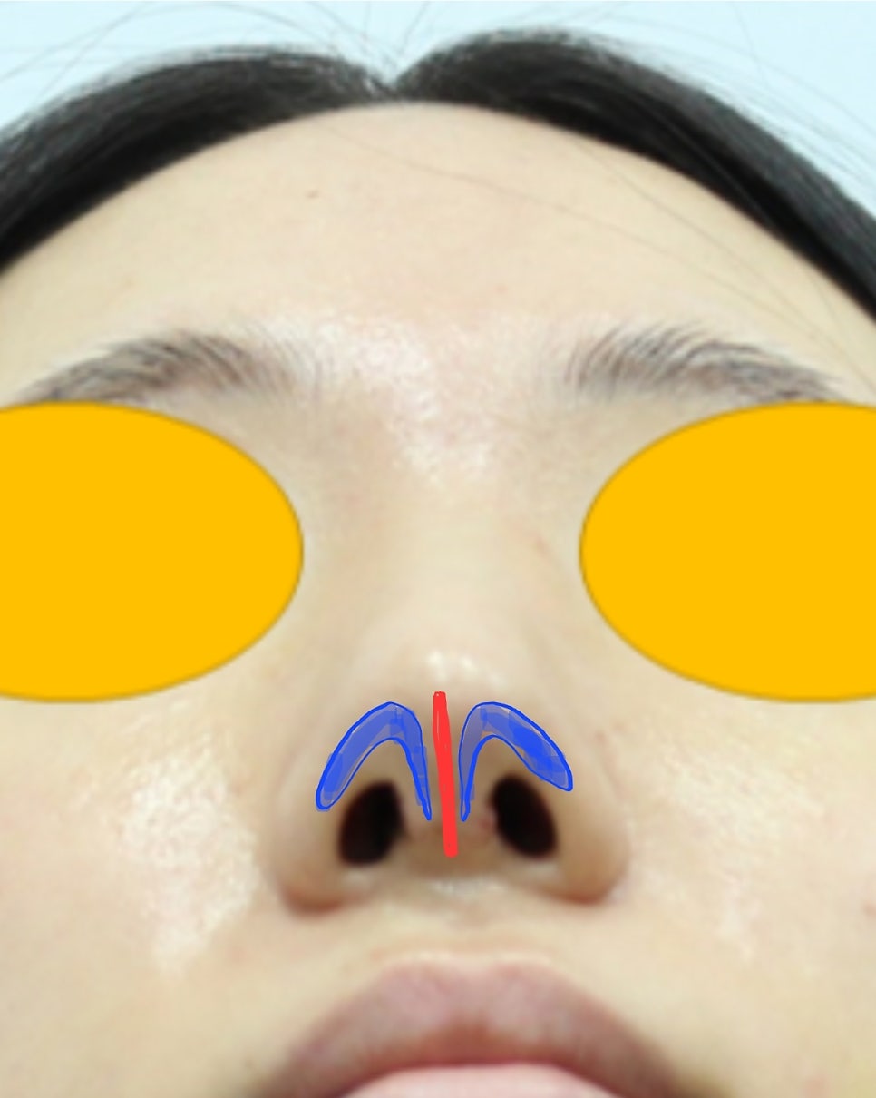 Various Surgical Methods for Crooked Nose Surgery image 5