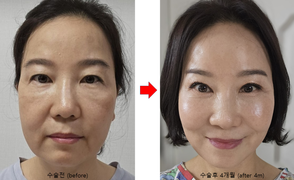 안티에이징 수술의 효과와 유지기간 관련 이미지 3