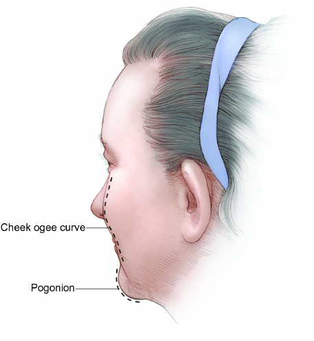 중안면의 볼륨감과 오지라인(Ogee curve) 관련 이미지 1