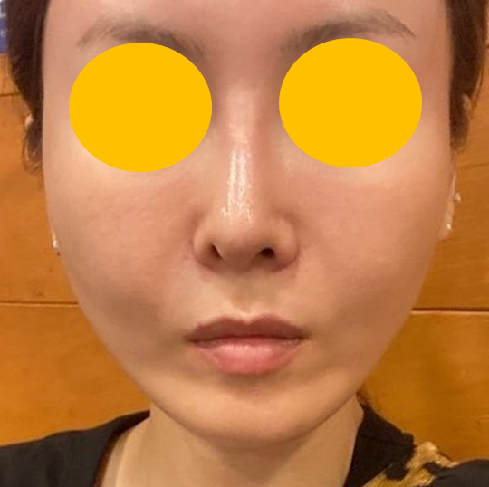 안면거상 해부학을 적용한 실리프팅, 오래가고 자연스러운 이유 관련 이미지 4