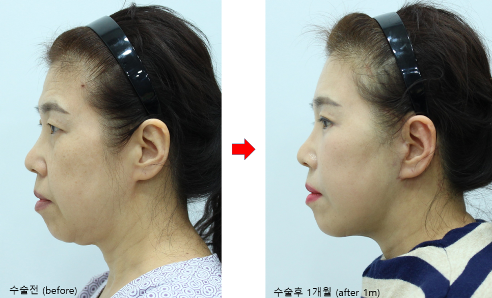 중년종합성형 상담과 수술의 범위 관련 이미지 5