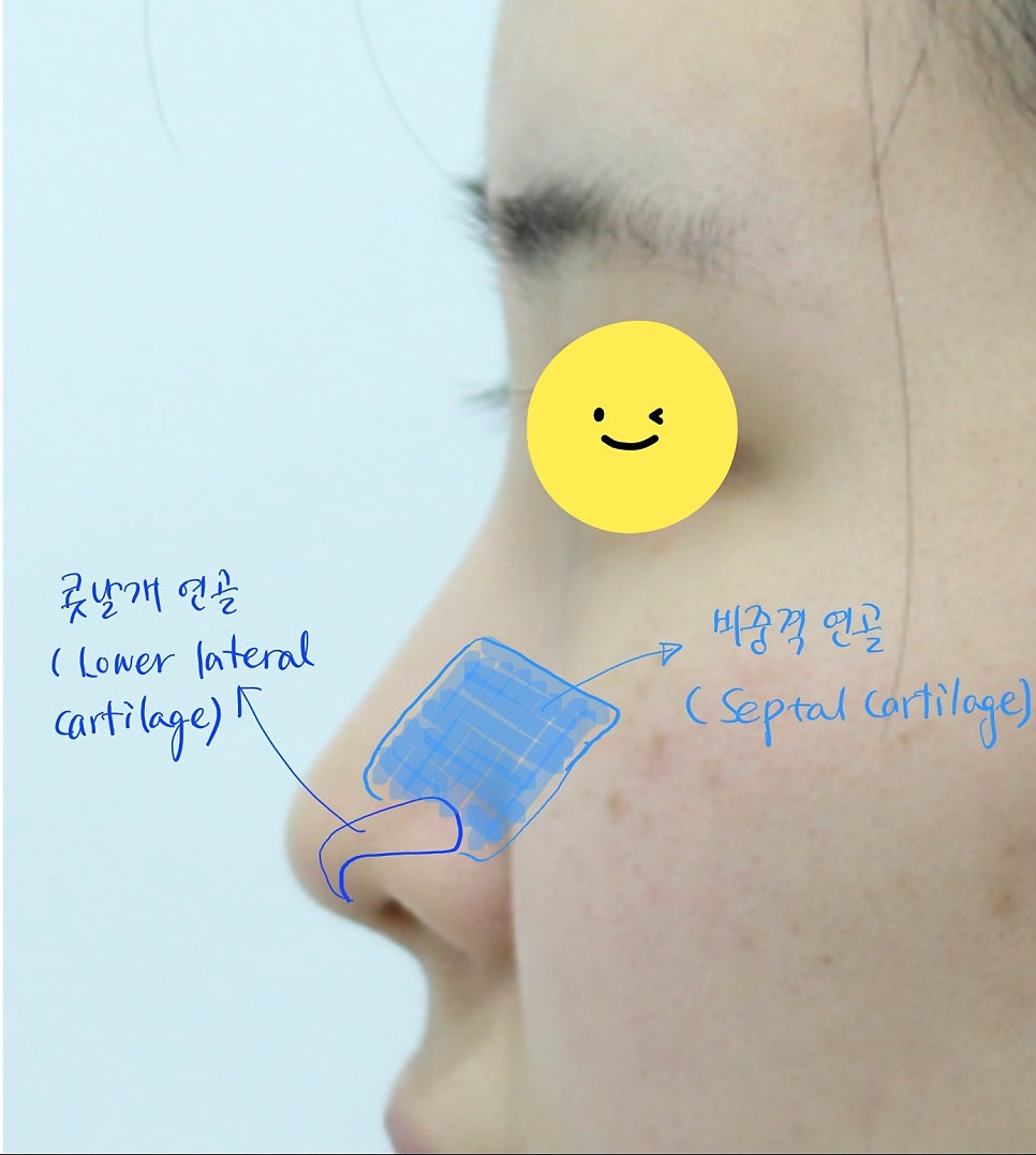 코성형에서 비중격 연골과 귀연골의 용도 관련 이미지 2