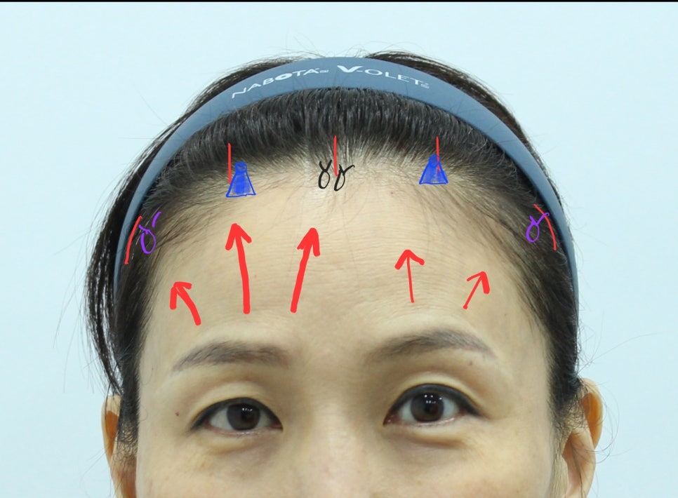Forehead Lift to Correct Eyebrow Asymmetry image 5