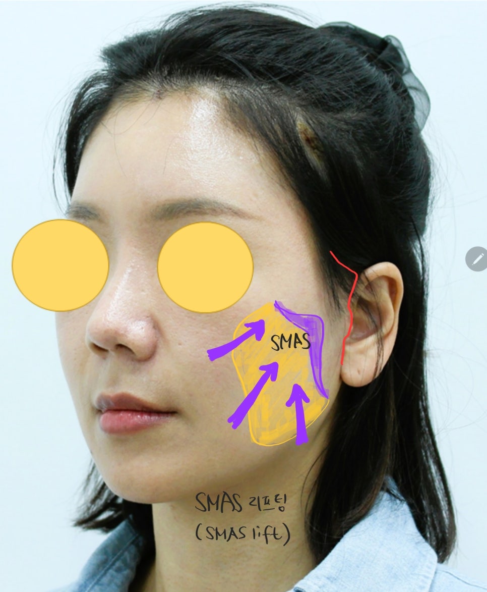 Areas of the Face Improved by a Deep Mini Facelift image 5