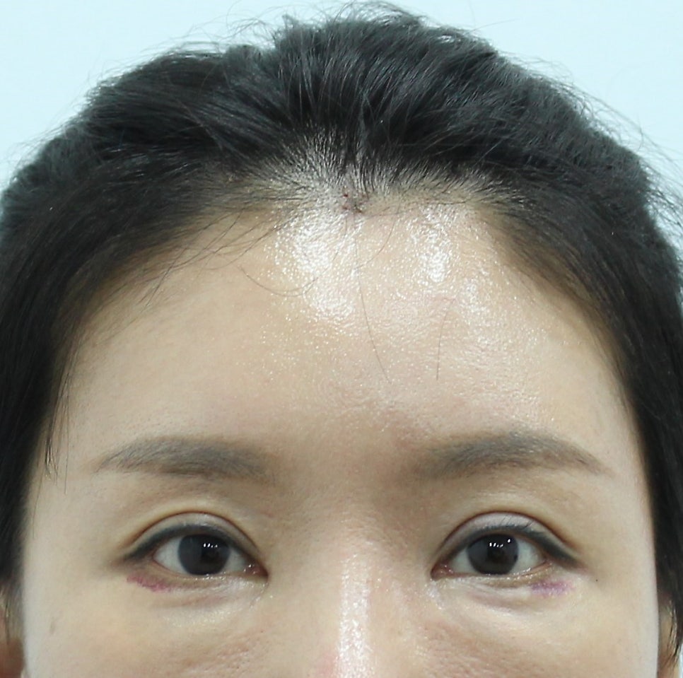 Forehead Lift After Upper Blepharoplasty image 9