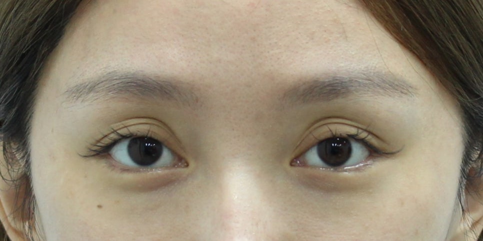 Micro Fat Filters and Micro Cannulas Used for Fat Grafting Around the Eyes image 1