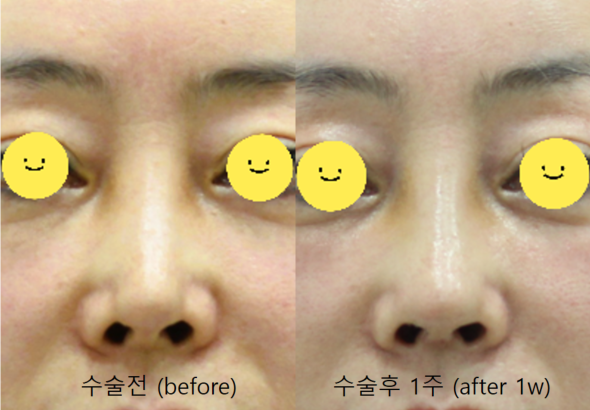 Correction of a Pinched Nose or Indented Nose image 8