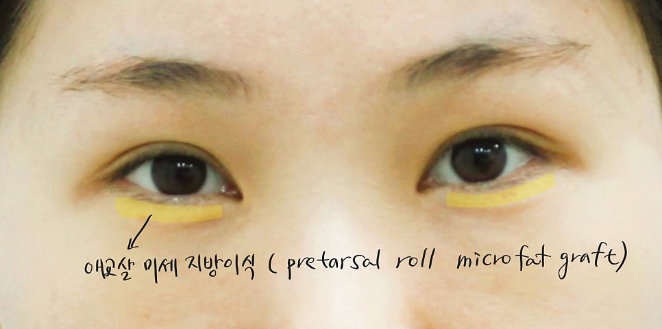 Under-Eye Fat Repositioning and Aegyo-Sal Fat Grafting image 6