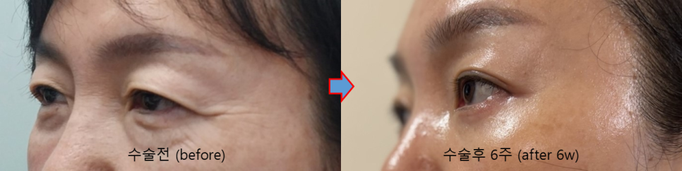 Why Horizontal Nasal Bridge Wrinkles and Eyelid Ptosis Occur Together, and the Role of Brow Lift Surgery image 5