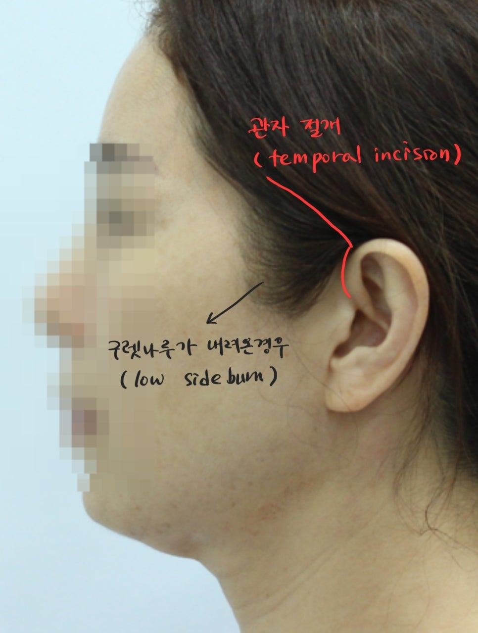 안면거상에서 절개선의 선택방법 관련 이미지 1