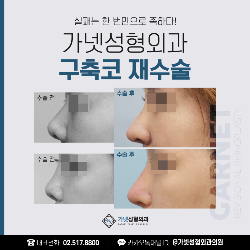[가넷성형외과 언론보도] 구축코재수술시기와 주의사항은? 관련 이미지 1