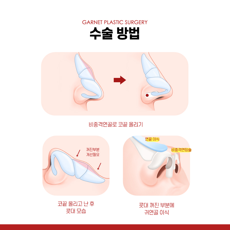 【가넷성형외과 백인수원장 성형칼럼】 매부리코 무보형물코성형 관련 이미지 4