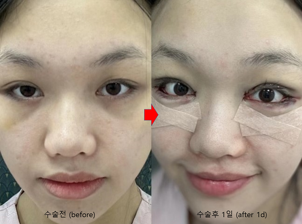 시원한 눈매를 위한 눈매교정 관련 이미지 7