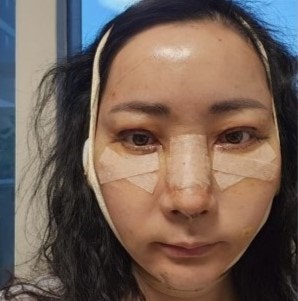 The Surgery Time and Recovery Period for Various Middle-Age Anti-Aging Surgeries image 8