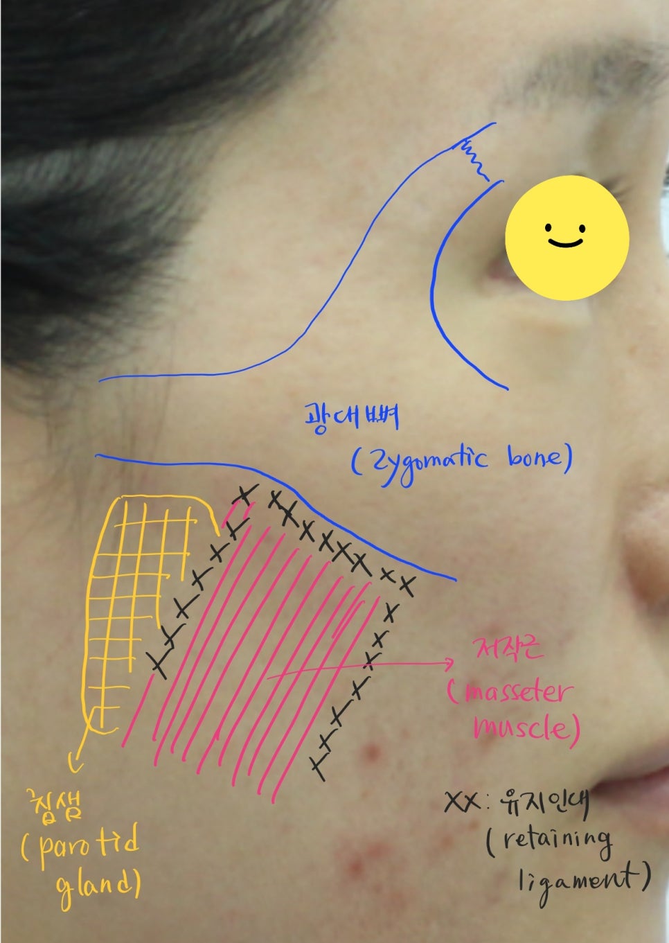 A Specialized Fat Grafting Correction Method for Hollowed Side Cheeks image 4