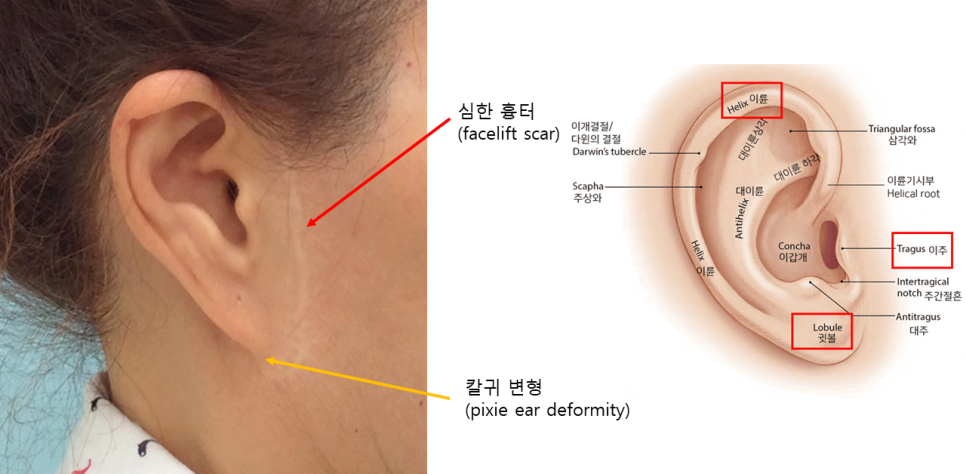 안면거상후 흉터 성숙과정 관련 이미지 2